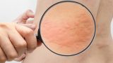 Коронавирус может провоцировать заболевания кожи — дерматолог